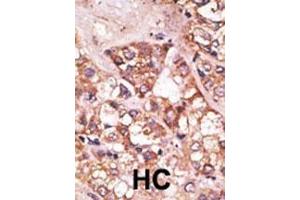 Formalin-fixed and paraffin-embedded human cancer tissue reacted with the primary antibody, which was peroxidase-conjugated to the secondary antibody, followed by AEC staining. (BIK Antikörper  (AA 39-74))