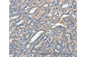 Immunohistochemistry of Human colon cancer using ANGPT1 Polyclonal Antibody at dilution of 1:50 (Angiopoietin 1 Antikörper)