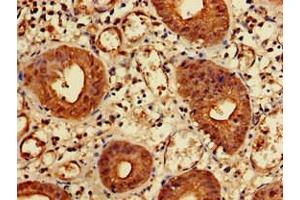 Immunohistochemistry of paraffin-embedded human colon cancer using ABIN7157550 at dilution of 1:100 (KIDINS220 Antikörper  (AA 1077-1370))