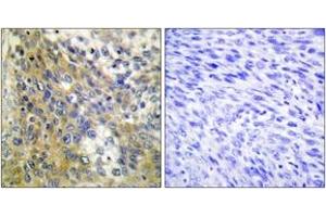 Immunohistochemistry analysis of paraffin-embedded human cervix carcinoma tissue, using Collagen IV alpha6 Antibody.