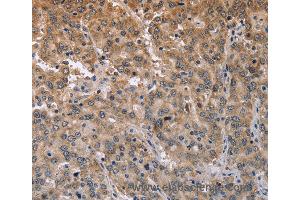 Immunohistochemistry of Human liver cancer using ECE1 Polyclonal Antibody at dilution of 1:50 (MAPRE3 Antikörper)