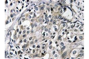 Immunohistochemistry (IHC) analyzes of TAT antibody in paraffin-embedded human breast carcinoma tissue. (HTATSF1 Antikörper)