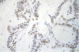 Immunohistochemistry was performed on paraffin-embedded human sigmoid colon carcinoma using phospho-p53 (S33) antibody (ABIN7800680), 1:200).