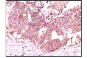 Immunohistochemical analysis of paraffin-embedded human recturn adenocarcinoma tissue showing cytoplasmic localization using FGF2 mouse mAb with DAB staining.