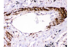 Anti- SHP2 Picoband antibody,IHC(P) IHC(P): Human Lung Cancer Tissue (PTPN11 Antikörper  (N-Term))