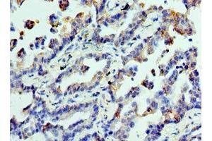 Immunohistochemistry of paraffin-embedded human lung cancer using ABIN7147858 at dilution of 1:100 (CLTA Antikörper  (AA 1-218))