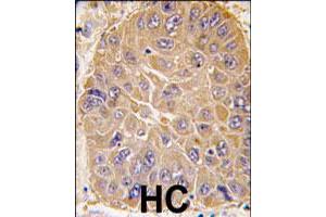 Formalin-fixed and paraffin-embedded human hepatocellular carcinoma reacted with ALDH5A1 polyclonal antibody  , which was peroxidase-conjugated to the secondary antibody, followed by DAB staining. (ALDH5A1 Antikörper  (N-Term))