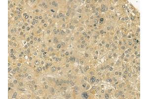ABIN6258723 and ABIN6274903 at 1/100 staining human hepatocellular carcinoma by IHC-P. (GCNT7 Antikörper  (Internal Region))