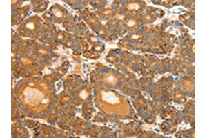 The image on the left is immunohistochemistry of paraffin-embedded Human thyroid cancer tissue using ABIN7192287(SCT Antibody) at dilution 1/40, on the right is treated with synthetic peptide.