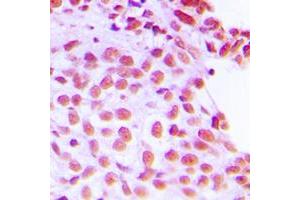 Immunohistochemical analysis of FEN1 staining in human breast cancer formalin fixed paraffin embedded tissue section. (FEN1 Antikörper  (Center))