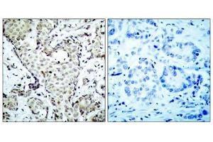 Immunohistochemical analysis of paraffin-embedded human breast carcinoma tissue, using MKK6 (Ab-207) antibody (E021153). (MAP2K6 Antikörper)