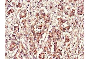 Immunohistochemistry of paraffin-embedded human pancreatic cancer using ABIN7152398 at dilution of 1:100 (FBXL22 Antikörper  (AA 123-229))