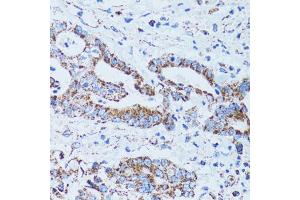 Immunohistochemistry of paraffin-embedded human colon carcinoma using GIP antibody (ABIN5973668) at dilution of 1/100 (40x lens). (GIP Antikörper)