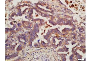 Formalin-fixed and paraffin embedded human lung carcinoma labeled with Rabbit Anti-MSH6 Polyclonal Antibody, Unconjugated 1:200 followed by conjugation to the secondary antibody and DAB staining (MSH6 Antikörper  (AA 812-910))
