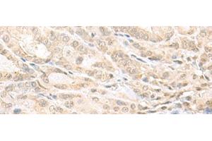 Immunohistochemistry of paraffin-embedded Human thyroid cancer tissue using EMX1 Polyclonal Antibody at dilution of 1:25(x200) (EMX1 Antikörper)