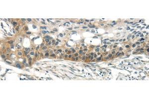 Immunohistochemistry of paraffin-embedded Human esophagus cancer tissue using WNT6 Polyclonal Antibody at dilution 1:35