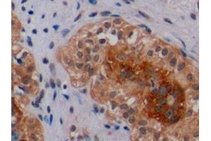 Detection of ErbB2 in Human Breast Cancer Tissue using Polyclonal Antibody to Receptor Tyrosine Protein Kinase erbB-2 (ErbB2) (ErbB2/Her2 Antikörper  (AA 23-372))