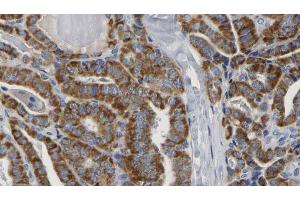 ABIN6267163 at 1/100 staining Human thyroid cancer tissue by IHC-P.