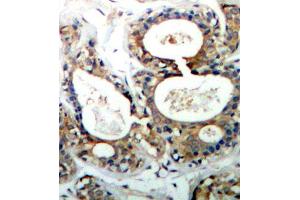 Immunohistochemistry of paraffin-embedded human breast carcinoma using Phospho-PTPN11-Y542 antibody (ABIN2987776). (PTPN11 Antikörper  (pTyr542))