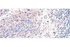 Immunohistochemistry of paraffin-embedded Human cervical cancer tissue using ESM1 Polyclonal Antibody at dilution of 1:50(x200) (ESM1 Antikörper)