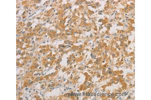 Immunohistochemistry of Human colon cancer using ZWINT Polyclonal Antibody at dilution of 1:50