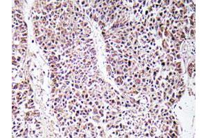 Immunohistochemical analysis of paraffin-embedded human liver carcinoma tissue using GDF9 polyclonal antibody . (GDF9 Antikörper)