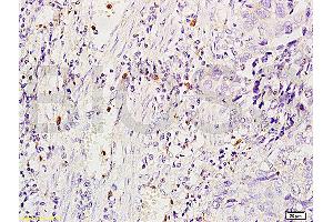 Formalin-fixed and human glioma tissue labeled with Anti-MSR1/CD204 Polyclonal Antibody, Unconjugated (ABIN872905) at 1:200 followed by conjugation to the secondary antibody and DAB staining (Macrophage Scavenger Receptor 1 Antikörper  (AA 211-320))