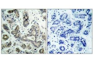 Immunohistochemical analysis of paraffin-embedded human breast carcinoma tissue using BAD(Phospho-Ser136) Antibody(left) or the same antibody preincubated with blocking peptide(right). (BAD Antikörper  (pSer136))