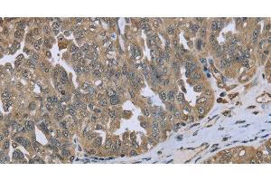 Immunohistochemistry of paraffin-embedded Human ovarian cancer tissue using DCTN4 Polyclonal Antibody at dilution 1:50 (Dynactin 4 Antikörper)