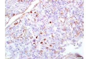 Formalin-fixed and paraffin embedded human lung carcinoma labeled with Anti CCL3/MIP 1? (CCL3 Antikörper  (AA 24-92))