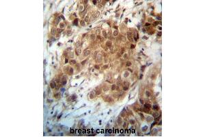 FOXO3 Antibody (N-term) (ABIN657229 and ABIN2846331) immunohistochemistry analysis in formalin fixed and paraffin embedded human breast carcinoma followed by peroxidase conjugation of the secondary antibody and DAB staining.