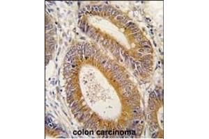 Formalin-fixed and paraffin-embedded human colon carcinoma tissue reacted with YARS2 antibody (N-term) (ABIN6244048 and ABIN6579016) , which was peroxidase-conjugated to the secondary antibody, followed by DAB staining.