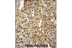 DEN1A Antibody (C-term) (ABIN653873 and ABIN2843124) IHC analysis in formalin fixed and paraffin embedded human cervix carcinoma followed by peroxidase conjugation of the secondary antibody and DAB staining. (DENND1A Antikörper  (C-Term))