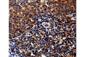 Immunohistochemistry of Human lung cancer using IL13RA1 Polyclonal Antibody at dilution of 1:50 (IL13 Receptor alpha 1 Antikörper)
