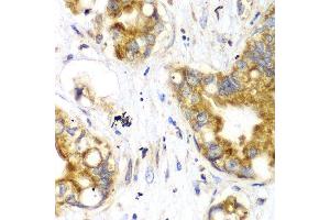 Immunohistochemistry of paraffin-embedded human liver cancer using TOMM20 antibody. (TOMM20 Antikörper  (AA 20-145))