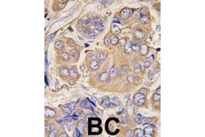 Formalin-fixed and paraffin-embedded human breast carcinoma tissue reacted with HSPB1 Antibody (S78) (ABIN391298 and ABIN2841334) , which was peroxidase-conjugated to the secondary antibody, followed by DAB staining. (HSP27 Antikörper  (AA 56-85))