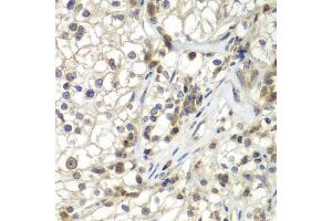Immunohistochemistry of paraffin-embedded human kidney cancer using ASPSCR1 antibody at dilution of 1:100 (x400 lens). (ASPSCR1 Antikörper)