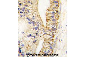 Formalin-fixed and paraffin-embedded human prostate carcinomareacted with CDH7 polyclonal antibody , which was peroxidase-conjugated to the secondary antibody, followed by AEC staining. (Cadherin 7 Antikörper  (N-Term))