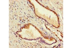 Immunohistochemistry of paraffin-embedded human prostate cancer using ABIN7177995 at dilution of 1:100 (ADCK2 Antikörper  (AA 200-609))