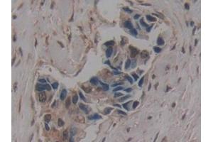 Detection of GLG1 in Human Breast cancer Tissue using Polyclonal Antibody to Golgi Glycoprotein 1 (GLG1)