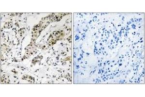 Immunohistochemistry analysis of paraffin-embedded human breast carcinoma, using TCEAL3/5/6 Antibody. (TCEAL3/5/6 Antikörper  (AA 141-190))