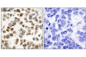 Immunohistochemical analysis of paraffin-embedded human breast carcinoma tissue, using BRCA1 (Ab-1423) antibody (E021234). (BRCA1 Antikörper)