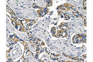 ABIN6258695 and ABIN6273499 at 1/100 staining human pancreatic cancer and adjacent non-tumor tissue by IHC-P.