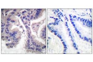 Immunohistochemical analysis of paraffin-embedded human lung carcinoma tissue, using Caspase 6 (cleaved-Asp162) antibody.