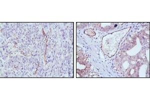 Immunohistochemical analysis of paraffin-embedded human stomach cancer (left) and ovary cancer (right) tissues using eNOS antibody with DAB staining. (ENOS Antikörper)