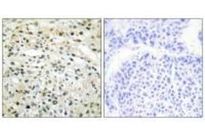 Immunohistochemistry analysis of paraffin-embedded human liver carcinoma tissue using DNMT3B antibody. (DNMT3B Antikörper  (N-Term))
