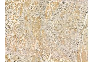 ABIN6262157 and ABIN6273254 at 1/100 staining human tongue carcinoma by IHC-P. (HBS1L Antikörper  (N-Term))