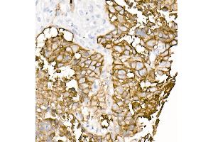 Immunohistochemistry of paraffin-embedded human lung squamous carcinoma tissue using TROP-2 Rabbit mAb (ABIN7271103) at dilution of 1:8100 (40x lens). (TACSTD2 Antikörper)