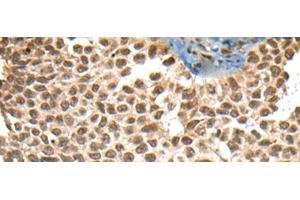 Immunohistochemistry of paraffin-embedded Human ovarian cancer tissue using XPO1 Polyclonal Antibody at dilution of 1:40(x200) (XPO1 Antikörper)