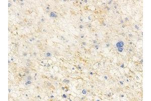 ABIN6265606 and ABIN6266929 at 1/100 staining human astrocytoma by IHC-P.